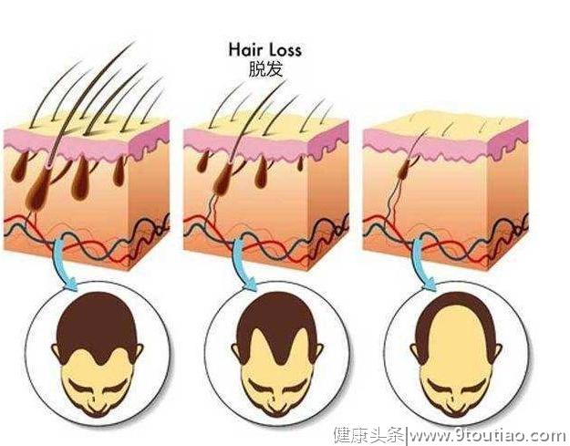 什么情况会导致脱发，哪些人一旦脱发，头发就不能复生了？