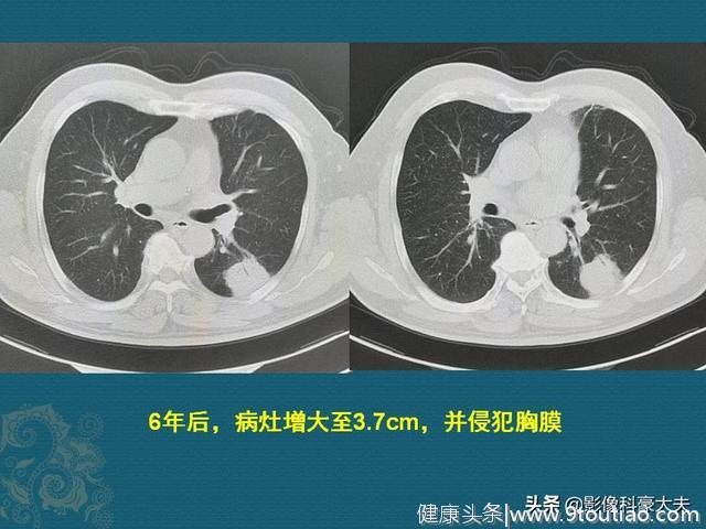 癌症病人也需要好运气，他发现肺腺癌，6年后才手术