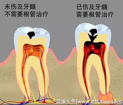 牙齿烂了一半，为什么不能补牙？