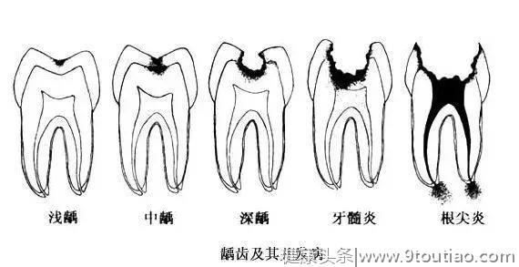 牙齿烂了一半，为什么不能补牙？