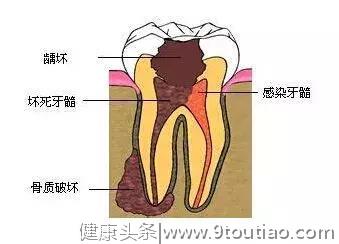 牙齿烂了一半，为什么不能补牙？