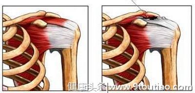 肩膀疼都是肩周炎？为什么治疗无效？肩周炎：这个黑锅我不背