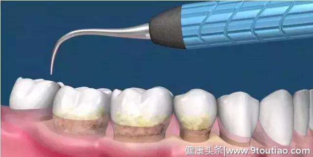 牙医最常见到的患者问题七大“最”