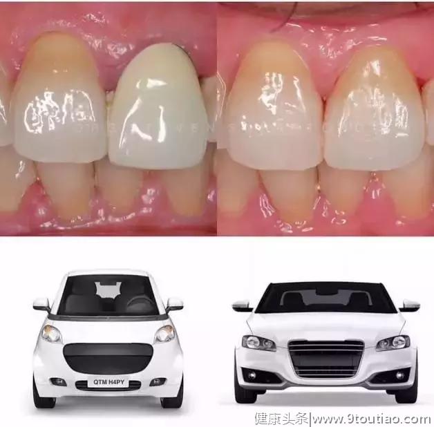 什么是全瓷牙？终于知道为什么牙医叫您选择全瓷牙
