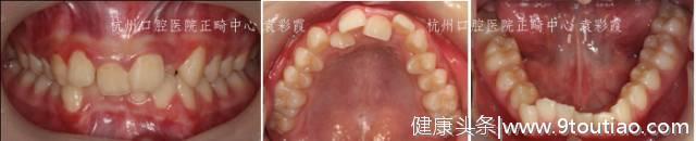 牙齿深覆合，对牙齿和脸型有什么影响？#葉子口腔科普#