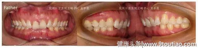 牙齿深覆合，对牙齿和脸型有什么影响？#葉子口腔科普#