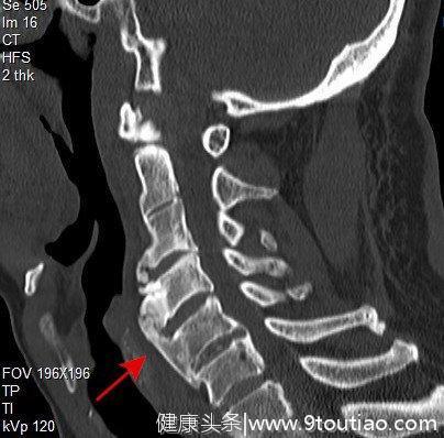 男子吞咽困难毛病却出在颈椎上？这种病年轻人中招的越来越多