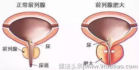 应 对 前列腺肥大的4个技巧