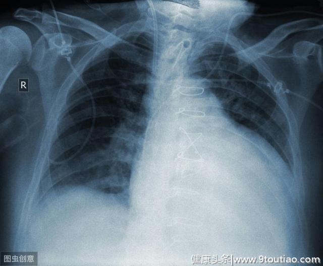 41岁男子，不痛不痒查出肺癌，医生：身体出现5个异常，请警惕