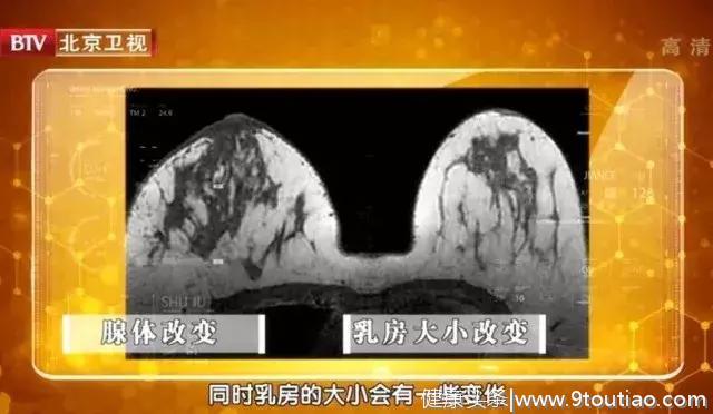 胸部出现“小酒窝”，当心是乳腺肿瘤！做好4件事，远离“女性杀手”