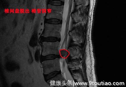 从腰间盘突出到脱出需要多久？医生：有可能只是一次错误的搬重物