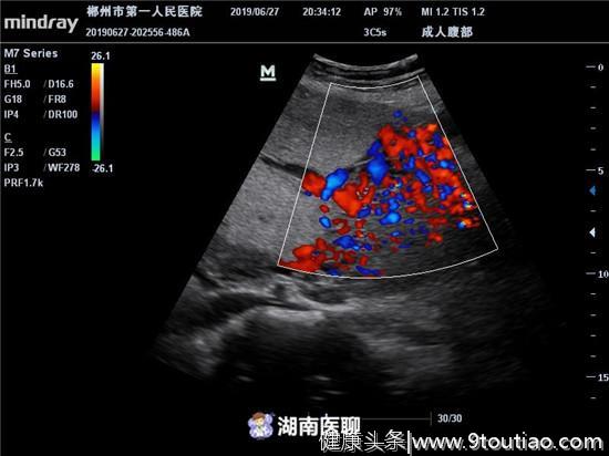 胎儿没在子宫而是长进腹中，34岁产妇腹腔内妊娠产下婴儿