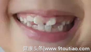 孩子换牙，长出的牙齿很丑、不整齐怎么办？