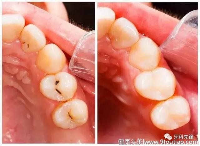 牙齿上有小黑点到失去牙齿要几步？