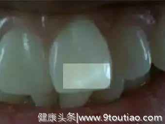 防蛀牙、改善白斑的护牙素怎么用？#葉子口腔科普#