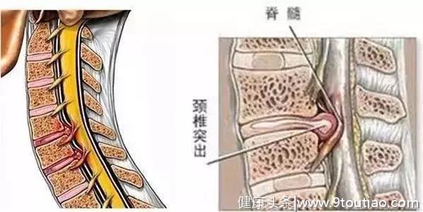 颈椎病的5种类型及应对办法，手术和保守治疗各有优劣