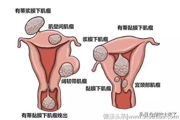 5个女人1个中招？子宫肌瘤怎么办？