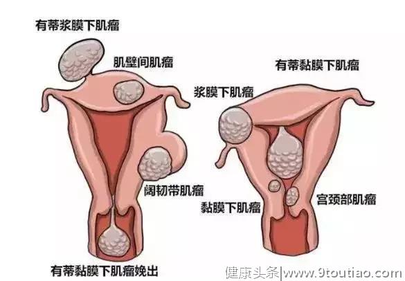 子宫肌瘤严重吗？听说有人要把整个子宫都切掉？