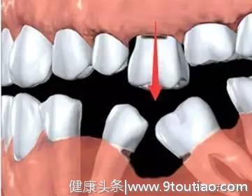牙齿缺失会影响外貌吗？