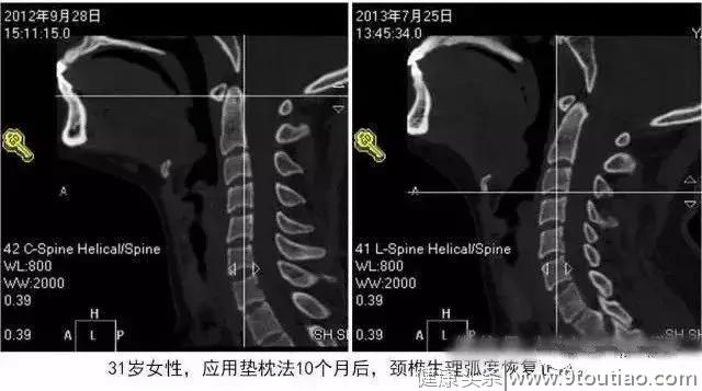 懒人垫枕疗法，来恢复颈椎生理曲度