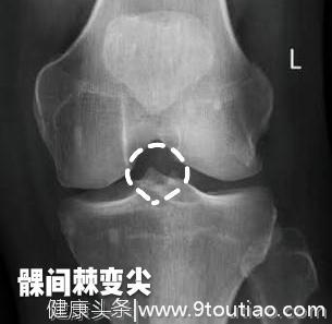 晨起双手发胀、僵硬、握不拢，一定是类风湿吗？有没有其他可能呢