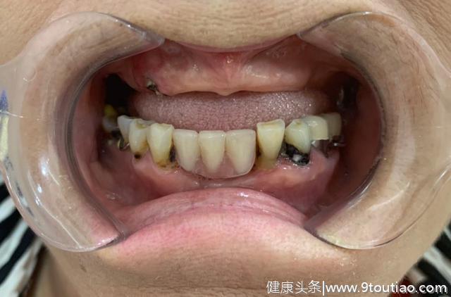 亲身实践半天恢复一口好牙！——奥运冠军妈妈种牙记