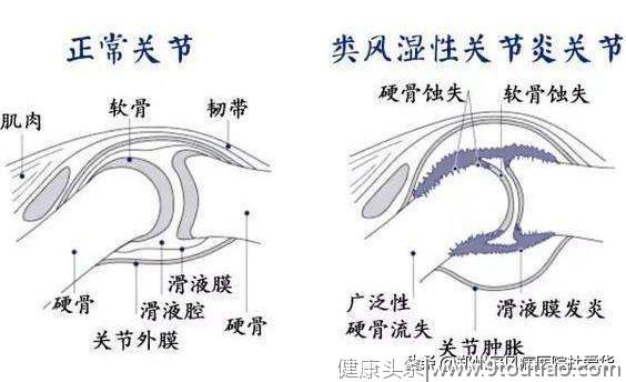 类风湿早期怎么判断？知道这6点，从手指上就能看出来