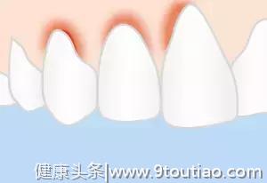 牙龈炎：牙齿炎症早期阶段