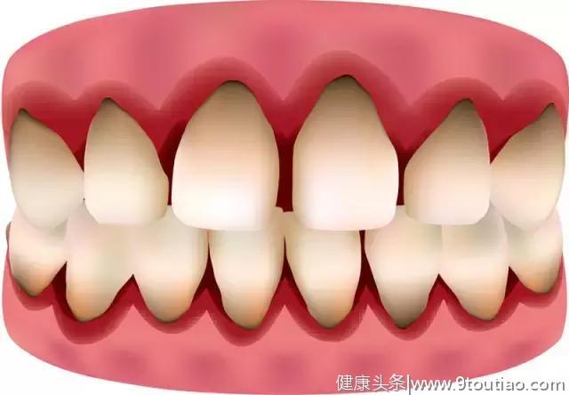 牙龈炎：牙齿炎症早期阶段