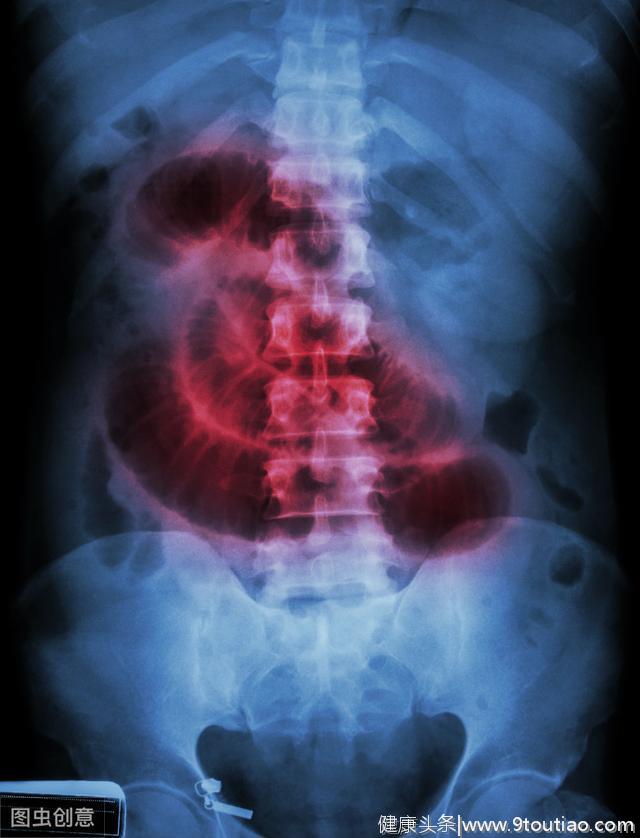 医生直言：肠癌不仅肚子疼，身体还会出现3个症状，一拖就是晚期