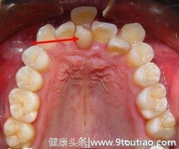 何预防儿童牙齿错位？淄博小孩子牙齿错位的危害