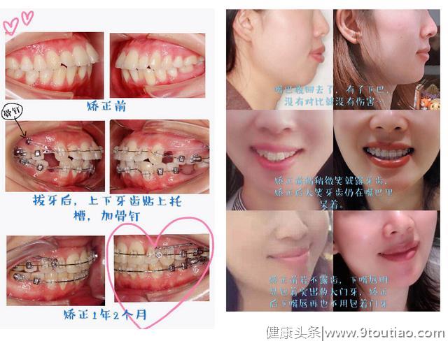 做牙齿矫正到底需不需要拔牙，这些冷知识你必须了解