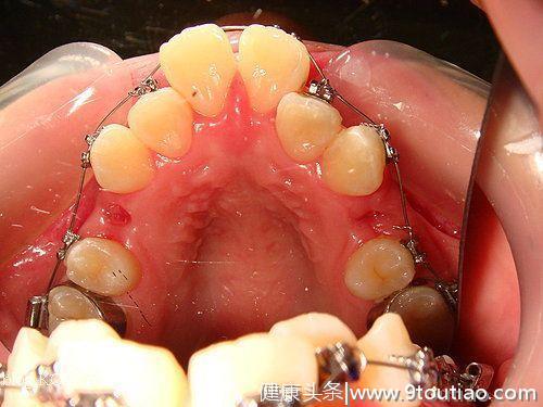 做牙齿矫正到底需不需要拔牙，这些冷知识你必须了解