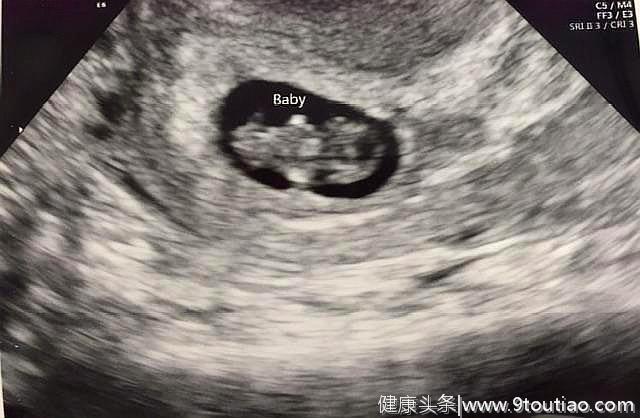 怀孕后的第一次产检，若三个指标都合格，恭喜你，胎儿很健康