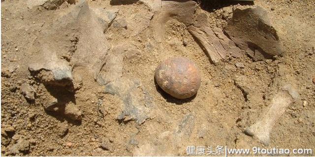 曾经发现的最古老的前列腺石建议一个人在12，000年前的痛苦中