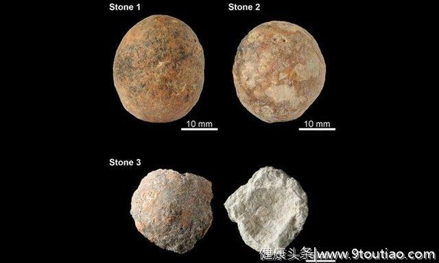 曾经发现的最古老的前列腺石建议一个人在12，000年前的痛苦中