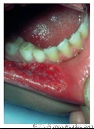 暑假在家意外多！这些儿童牙科急救常识必须要学#葉子口腔科普#