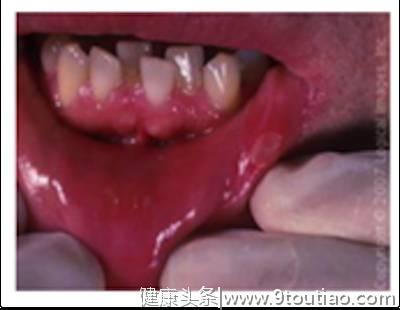 暑假在家意外多！这些儿童牙科急救常识必须要学#葉子口腔科普#