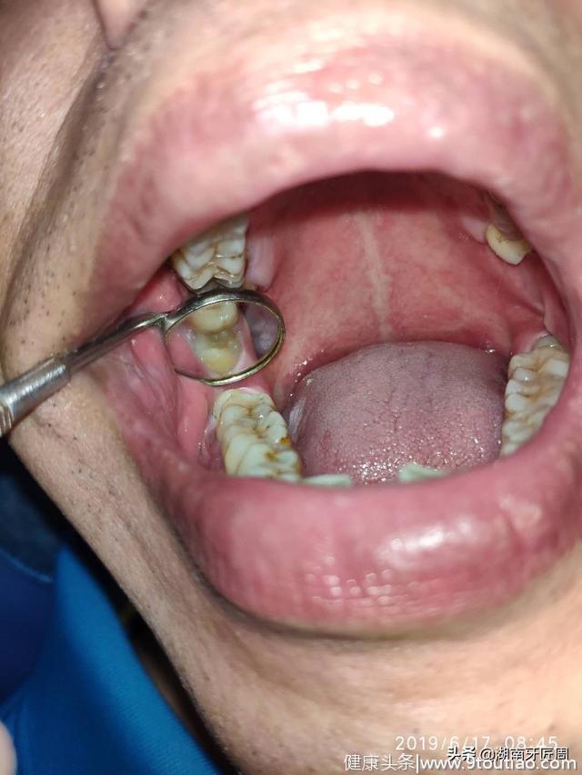你以为你的牙齿很健康？看完这个病例或许会让你马上想去口腔医院