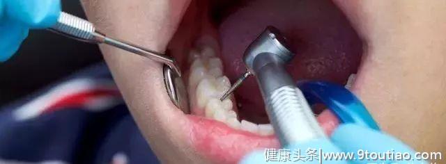 揭秘补牙全过程，看看牙医在你嘴里做了什么？