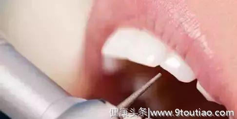 揭秘补牙全过程，看看牙医在你嘴里做了什么？