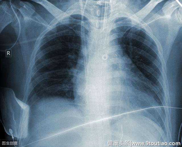 肺癌来前“没感觉”，这4种征兆若出现一个，快去医院做“造影”