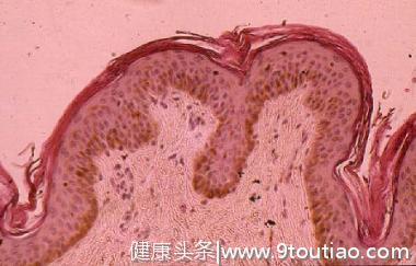 和肝癌有关的皮肤表现，你知道吗？这五种皮肤问题，要引起注意