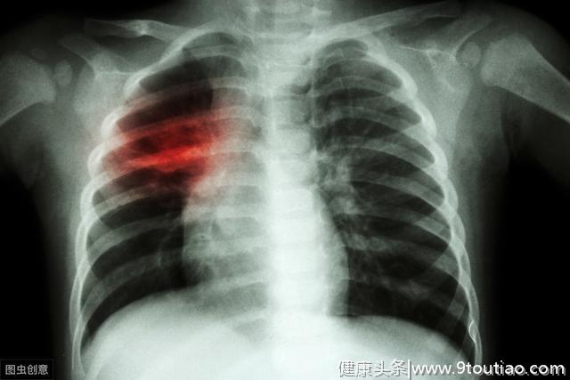 肺癌晚期身体会出现哪四个痛苦症状呢