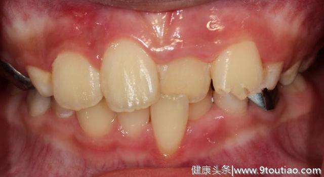 儿童牙齿问题，掌握黄金期，早期介入儿童牙齿矫正治疗