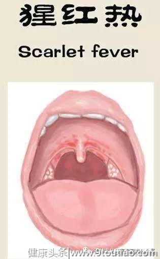 小儿猩红热不正规治疗危害大