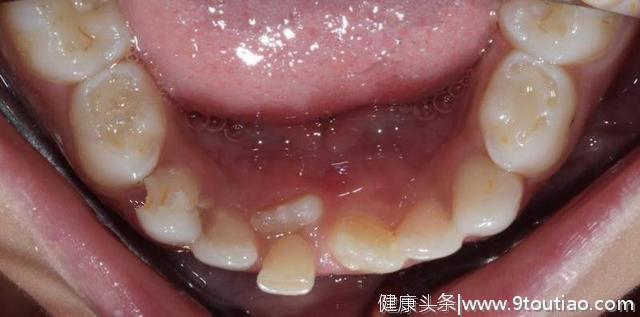 儿童牙齿问题，掌握黄金期，早期介入儿童牙齿矫正治疗