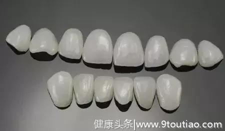 Helen齿科中心——全瓷贴面 修复牙齿上的小瑕疵