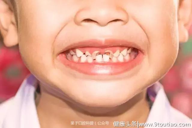 为什么孩子刚萌出的牙齿会更容易蛀牙？