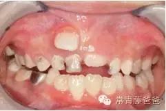 忽略牙齿健康可能影响孩子一生！-北大口腔医院儿童牙医案例分享